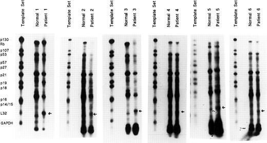Fig. 1. Abnormally high gene mRNA expression in PV erythroid progenitors. / Highly purified day-8 ECFCs were generated from 6 healthy donors and 6 patients with PV. Total RNAs were isolated and 20 μg of RNA were analyzed for the presence of RNA transcripts for p130, Rb, p107, p53, p57, p21, p19, p18, p16, p14/15 related to cell proliferation, using the hCC-2 Multi-Probe Template Set (Pharmingen). L32 andGAPDH were included as internal controls. RNase protection assays (RPAs) were performed with the MAXIscript and RPA II Ribonuclease Protection Assay Kits (Ambion) according to the manufacturer's protocols. Protected transcripts were separated by denaturing polyacrylamide gels and quantified by autoradiography. The band with a strikingly higher expression is indicated by an arrow.