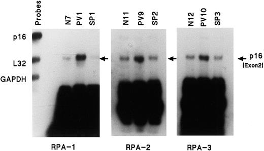 Fig. 3. Enhanced amount of mRNA transcript for p16 (exon 2) in PV ECFCs is not present in secondary polycythemia. / Experiments performed as in Figure 1, but with only p16, L32, and GAPDH gene probes. SP indicates secondary polycythemia.