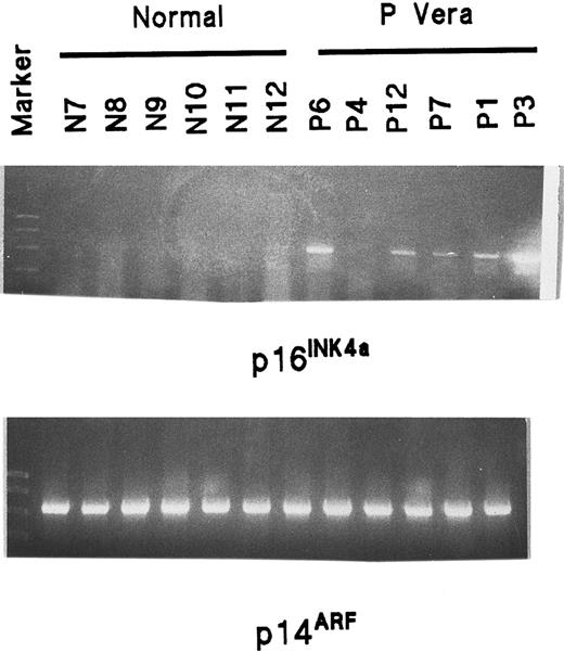Fig. 5. Analysis of p16INK4a and p14ARFmRNA expression in normal and PV ECFCs by RT-PCR. / Information concerning primers and length of products is shown in Table2. The markers show 1000, 750, 500, 300, 150, and 50 bp. The length of p16INK4a is 494 bp and the length of p14ARF is 571 bp.