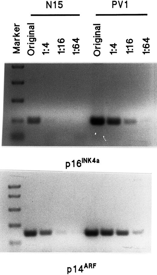 Fig. 6. Semiquantitative assay of p16INK4a and p14ARF mRNA transcripts by RT-PCR in normal and PV ECFCs. / The sequence of primers is shown in Table 2. The length of the p16INK4a amplification product is 142 bp and the length of p14ARF is 212 bp. The marker sizes on the top panel are 750, 500, 300, 150, and 50 bp whereas the markers on the bottom panel are 1000, 750, 500, 300, and 150 bp. The amount of original total RNA used for the RT-PCR was 80 ng, and 20 ng, 5 ng and 1.25 ng, respectively, were used for the dilutions of 1:4 to 1:64.