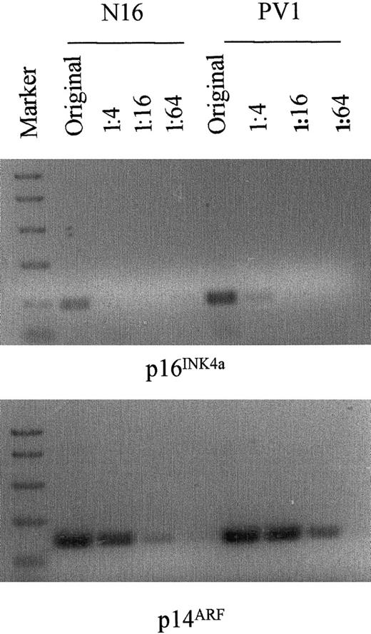 Fig. 7. Semiquantitative assay of p16INK4a and p14ARF mRNA transcripts by RT-PCR in normal and PV granulocyte-macrophage cells generated from blood CFU-GM. / The method is the same as in Figure 6.