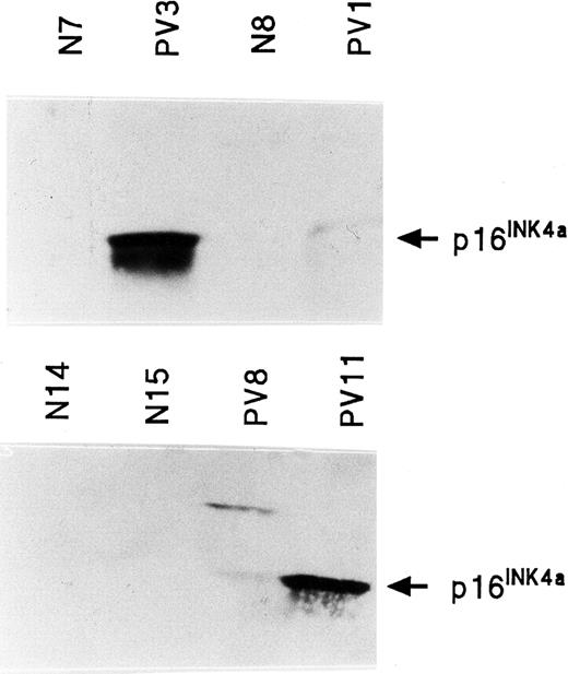 Fig. 8. INK4a protein (p16INK4a) expression in normal and PV ECFCs. / Two separate Western blots are shown in which PV3 and PV11 have very high levels of p16INK4a protein; PV1 and PV8 have lower levels. p16INK4a was virtually undetectable in all healthy ECFC protein extracts.