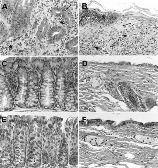 Fig. 5. Tissue sections of the large intestine and skin of BALB/c hosts given BMTs from C57BL/6 donors show no evidence of GVHD. / Sections are stained with hematoxylin and eosin, and magnified × 400. (A) A representative section of the large intestine from a positive control BALB/c host given lethal TBI (800 cGy) and an intravenous injection of 1.5 × 106 TCD bone marrow and 0.1 × 106 spleen cells 40 days earlier. Asterisk shows interstitial lymphocytic infiltrate, and arrowhead shows extension into crypt. Arrow shows apoptotic crypt cell. (B) A representative section of skin from the host in panel A. Arrow shows epidermal hyperplasia, arrowhead shows dermal infiltrate, and asterisk shows epidermal blister. Panels C and D show large intestine and skin, respectively, from a negative control BALB/c host given BCLl tumor cells, sublethal irradiation, and an intravenous injection of 50 × 106 TCD BM cells 40 days earlier. Panels E and F show representative sections of the large intestine and skin, respectively, from BALB/c hosts given BCL1 tumor cells, sublethal irradiation, and 25 × 106 whole BM cells 100 days earlier.