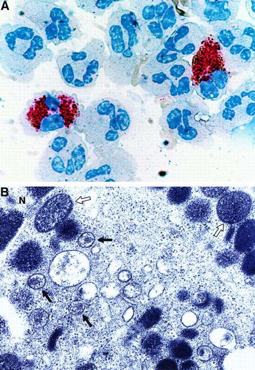 Fig. 5. Retroviral analysis of the in vivo–differentiated MCs/basophils in the blood of patients with AIDS. / In the depicted experiment, the cells in the peripheral blood of a patient with both AIDS and asthma were stained with anti-HIV-1 p24 IgG (brown) followed by anti-tryptase IgG (pink) (A). Similar tryptase+/p24+ MCs/basophils were found in the blood of 5 other patients with AIDS. In the negative control experiments, immunoreactive p24 was not detected in the tryptase+ MCs/basophils present in 3 asthma patients that were not infected with HIV-1 (data not shown). Because the immunohistochemical data indicated the presence of viral protein, electron microscopy was carried out to evaluate whether or not the MCs/basophils in 2 of these patients contain intact retrovirus (B). The open and closed arrows in the depicted electron micrograph indicate secretory granules and intact retrovirus, respectively, in these MCs/basophils. N refers to the nucleus. Although certain populations of human eosinophils are susceptible to HIV-1 ex vivo,59 the depicted HIV-1–infected cell clearly is not an eosinophil, T cell, or macrophage based on its ultrastructure.
