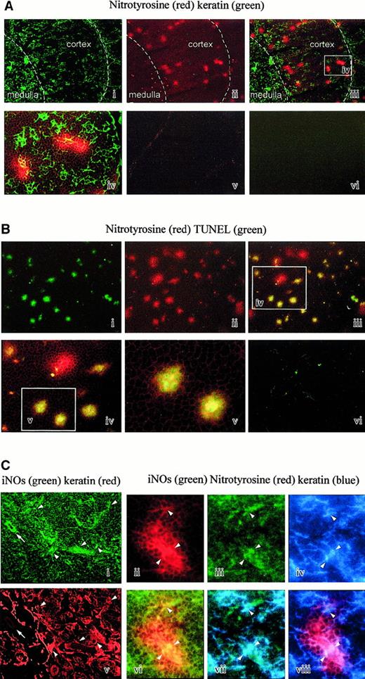 Fig. 9. Analysis of nitrotyrosine on thymic sections. / (A) Nitrotyrosine and keratin double staining. Nitrotyrosine spots (red staining) are mainly observed in the cortex and at the corticomedullary junction (i). Double staining with antikeratin antibody delineates the cortex and the medulla (ii, iii). The superimposed microphotography is shown in panel Aiii (× 25). A higher magnification of the white rectangle (iv) shows that some epithelial cells (green staining) are often contained in the nitrotyrosine spots (× 100). The control performed by absorbing the antinitrotyrosine activity with competing nitrotyrosine is negative (v). The control performed by omitting the first layers is also negative (vi). (B) Nitrotyrosine and TUNEL double staining. Nitrotyrosine spots (red staining) in a cortical area (ii) are often associated with cells positive in a TUNEL reaction (green staining) (i, iii) (× 25). Double-stained cells are shown at a higher magnification of the white rectangle (iii-v). It appears that most but not all nitrotyrosine spots are associated with a TUNEL reaction (× 100). The control is negative (vi). (C) Nitrotyrosine, keratin, and iNOS triple staining. Epithelial cells (ii) are frequently iNOS+ (i), shown by the arrowhead, but keratin-negative cells are also iNOS+, shown by the arrow. Nitrotyrosine spots (iii) could include iNOS+ (iv) keratin-positive cells (v). Superimposition of antinitrotyrosine (iii) and iNOS (iv) staining is shown in panel Cvi. Superimposition of iNOS (iv) and antikeratin (v) staining is shown in panel Cvii. Superimposition of antinitrotyrosine (iii) and antikeratin (v) staining is shown in panel Cviii.