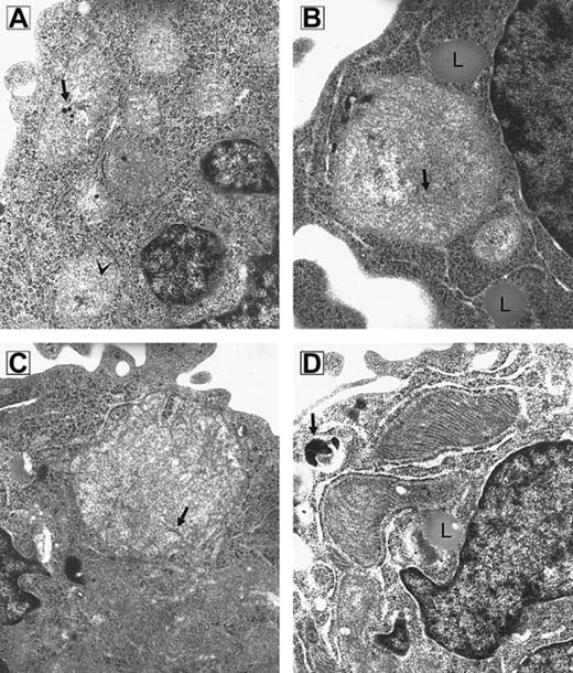 Fig. 1. RPMI 8226 myeloma cells. / Electron micrograph composite of an untreated RPMI 8226 myeloma cell (A) and cells treated for 4 hours (B), 8 hours (C), and 16 hours (D) with 180 μM imexon (original magnification × 49 500). (A) Small mitochondria with sparse cristae (arrowhead) and calcific bodies (arrow) are seen. (B) Megamitochondrion in association with lipid droplets (L); cristae are indicated by arrow. (C) Megamitochondrion; arrow indicates cristae. (D) Mitochondria are electron dense with abundant cristae. A lipid droplet (L) is seen in proximity to mitochondria. A secondary lysosome is indicated by the arrow.