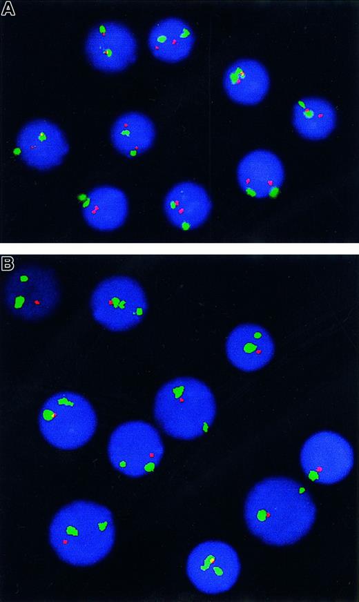 Fig. 1. FISH analysis of. / p53 gene copy number in SLVL. Double-color FISH analysis using a probe for chromosome 17 centromere (green signal) and locus-specific probe for p53 (red signal) allowing for identification of cases with one signal for the p53 probe due to monosomy 17. (A) Normal control showing 2 signals for centromere 17 and 2 signals for p53. (B) A patient with hemizygous deletion of p53 (2 green and 1 red signals).