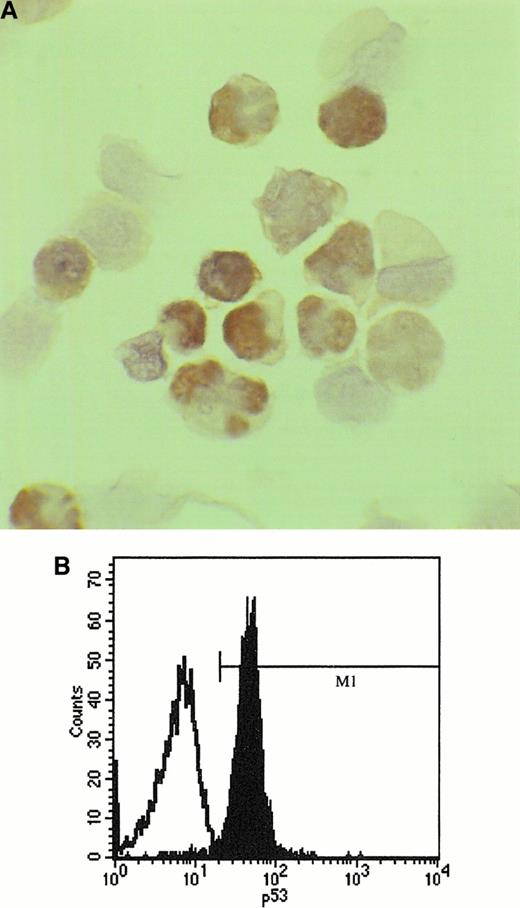 Fig. 2. Analysis of p53 protein expression in SLVL. / (A) Positive staining with anti-p53 antibody (clone DO7) using peroxidase-antiperoxidase method on a cytospin preparation of separated spleen cells from a patient with SLVL. p53 is visualized as brown precipitate in the nucleus of the cells. (B) Flow cytometric analysis of p53 protein expression in a patient with SLVL; cells were fixed with paraformaldehyde and permeabilized with 80% ethanol. In an indirect staining protocol, a monoclonal antibody (clone DO1) recognizing an epitope comprising amino acids 11 to 25 of the p53 molecule was used for detection of p53 expression or an isotypic control was used as first layer followed by a second layer—FITC-conjugated goat antimouse IgG F(ab)2.