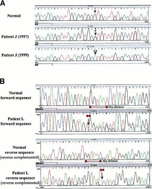 Fig. 3. Mutational analysis of p53 by direct sequencing in SLVL. / Sequencing was performed in 9 patients with p53 deletion or protein expression or both. p53 mutations were identified in 2 patients. (A) A point missense transition mutation in codon 273 in patient J changing CGT (Arg) to CAT (His), heterozygous (*) at diagnosis, which became homozygous (**) 2 years later. (B) A heterozygous 6-bp deletion (2 entire codons: 262-263), leading to a protein lacking 2 amino acids (Gly-Asn), at the beginning of exon 8 in patient L.