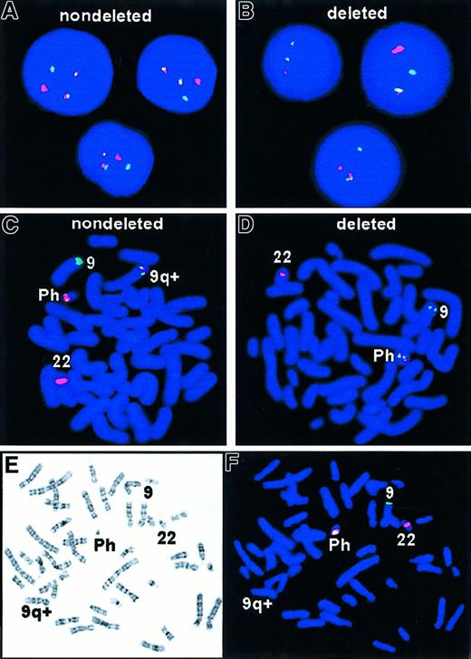 Fig. 1. FISH analysis of t(9;22) with deletion. / R = red signal; G = green signal; F = fusion color signal (red/green or yellow). (A) Expected D-FISH signal pattern in Ph+ interphase, 1R1G2F. (B) Atypical D-FISH signal in Ph+ interphase with deletions, 1R1G1F. (C) Expected D-FISH signal pattern in Ph+ metaphase, 1R1G2F. (D) Atypical D-FISH signal in Ph+ metaphase with deletions, 1R1G1F. Colocalization of red and green signals (ABL and BCR) identified the Ph chromosome. A single red signal was seen on the normal chromosome 22 homologue and a single green signal on normal chromosome 9. (E,F) Sequential G-banding and D-FISH analysis of a Ph+ metaphase with deletions of 5′ ABL and 3′ BCR sequences and corresponding loss of the second fusion second signal on the derivative chromosome 9.