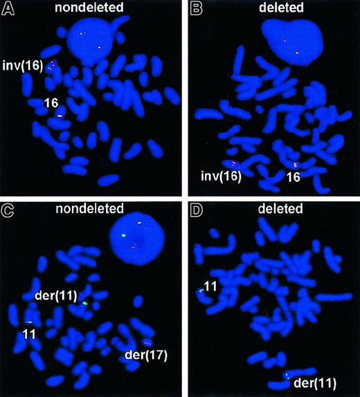 Fig. 2. FISH analyses of inv(16) and. / MLL deletions. With the LSI CBFBdual-color probe, the normal 16q22 region appears as adjacent red-green or a fused yellow signal. On a metaphase preparation, the inv(16) will have red and green signals on opposite arms of the aberrant chromosome. (A) Expected signal pattern with the LSI CBFB of a metaphase containing an inv(16), with red and green signals appearing on opposite arms of the inverted 16 chromosome. (B) Atypical signal pattern with LSI CBFB of a metaphase containing inv(16) and deletion of 3′ sequences of CBFB gene. Spectrum Green–labeled probe failed to hybridize to the 16q22 region, providing evidence that at least 170 kb of the region 3′ to CBFB gene is deleted with this inversion. (C) Interphase nucleus and metaphase cell showing the results of LSI MLL hybridized to a specimen possessing a t(11;17)(q23;p13). As expected for a rearrangement at theMLL breakpoint, the orange signal has moved to the p arm of chromosome 19, and the green signal has remained on the q arm of chromosome 11. On the normal chromosome 11 the LSI MLL probe green and orange signals (fused yellow) remain unchanged. The interphase nucleus showed one green/orange fused signal representing the normal chromosome 11 and separate green and orange signals representing the translocation chromosomes. (D) Atypical signal pattern with LSI MLL of a metaphase containing t(9;11)(p22;q23) accompanied by the deletion of a 3′ region of MLL gene with the corresponding loss of orange signal. Spectrum Orange–labeled probe failed to hybridize to the 3′ region of MLL gene, providing the evidence that at least 190 kb of the region that is telomeric to the gene was deleted.