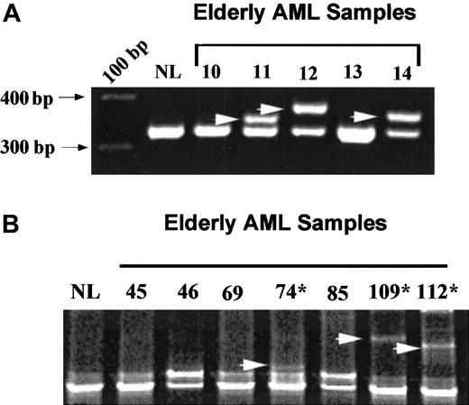 Fig. 2. FLT3 mutations (ITDs) in elderly AML patients. / (A) PCR products of the FLT3 gene after electrophoresis through a 2% agarose gel. The PCR products from a normal bone marrow (NL, left lane) and elderly AML samples 10 to 14 are demonstrated. High-molecular-weight bands in samples 11, 12, and 14 (arrows) were confirmed to have mutations by direct nucleotide sequencing. (B) SSCP analysis of PCR product from a normal bone marrow (NL, left lane) followed by elderly AML samples 45, 46, 69, 74, 85, 109, and 112. The 7 elderly AML samples had normal-appearing bands with agarose electrophoresis. Arrows point to shifted bands in patient samples 74, 109, and 112. Direct nucleotide sequencing confirmed ITDs in samples 74, 109, and 112.