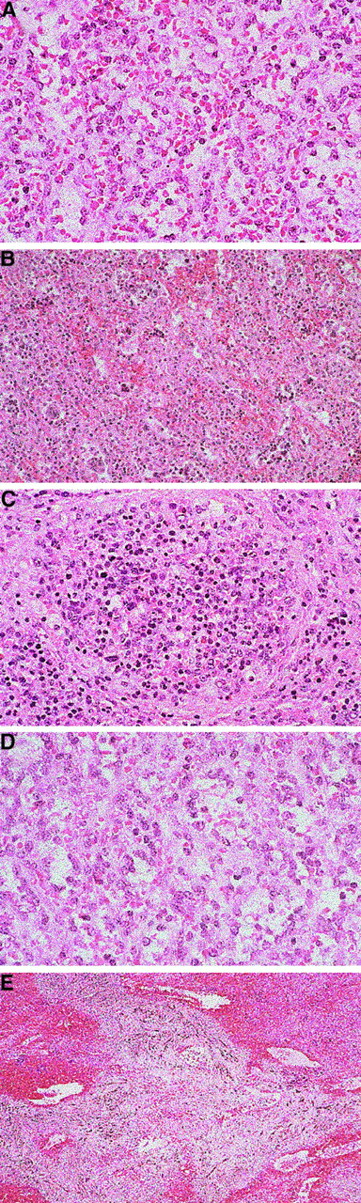 Fig. 1. Splenic histologic findings in patients with myelofibrosis with myeloid metaplasia. / (A) Normal spleen (× 128). (B) Diffuse splenic EMH (× 128). (C) Nodular splenic EMH (× 80). (D) Immature granulocytic predominant EMH (× 128). (E) Splenic microinfarction (× 51).