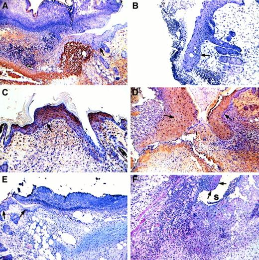 Fig. 2. Immunohistochemical analysis of fibrin- (ogen), fibronectin, and procollagen I in wounds of control and Fib−/− mice. / Fibrin(ogen) immunodetection (brown reaction product) in the wound beds of control (A) but not in Fib−/− (B) mice on day 4. Note that the epithelium and the granulation tissue of the wounds contain abundant fibronectin (brown reaction product) in both control (C) and Fib−/− (D) mice. Procollagen I accumulation (pink reaction product) was more prominent in Fib−/− mice (F) than in control mice (E). Original magnification, 100×.