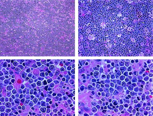 Fig. 1. Histologic features of BLL. / The lymphoma is diffuse, with a starry-sky pattern due to admixed phagocytic macrophages, and is composed of medium-sized lymphoid cells showing a jigsaw puzzle effect of cytoplasmic borders. The nuclei vary in size and shape, and the mitotic rate is high (paraffin sections stained with hematoxylin and eosin; upper panels, original magnification × 40 and × 100; lower panels, × 400).