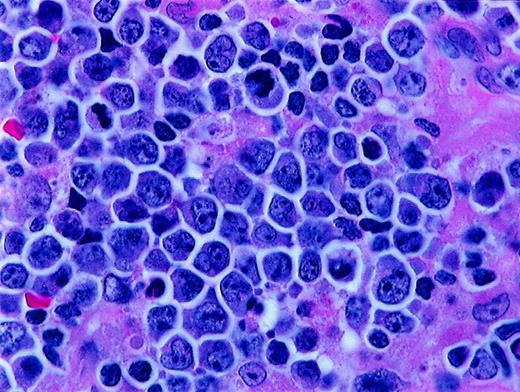 Fig. 2. Histologic features of BLL. / Higher magnification of BLL sample reveals nuclear polymorphism with various nuclear shapes and polylobation of some nuclei (hematoxylin and eosin stain, × 1000).