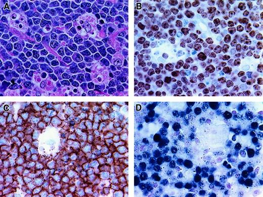 Fig. 4. Histologic and phenotypic features of BLL. / (A) Starry-sky pattern (hematoxylin and eosin stain of paraffin section, × 400). (B) Nearly all neoplastic cells are proliferating, as demonstrated by reactivity with Ki-67 (frozen section, × 400). (C) Strong CD20 reactivity of BLL cells (frozen section, × 400). (D) Positivity for EBV detected by EBER in situ hybridization (paraffin section, × 400).