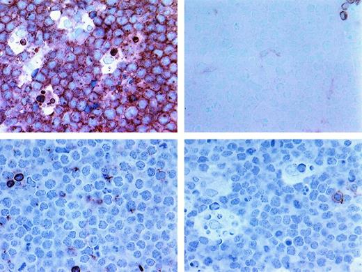 Fig. 5. Additional phenotypic features of BLL. / Upper left shows strong expression of CD10 in BLL sample (frozen section, × 400); upper right, near-absent expression of Bcl-2 in BLL cells (paraffin section, × 400); lower left, near-absent expression of LFA in BLL cells (frozen section, × 400); and lower right, low T-TIL numbers as assessed by reactivity of only rare cells with CD8 (frozen section, × 400).
