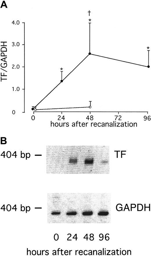 Fig. 2. Increased TF RNA expression in whole blood after AMI. / (A) Serial changes in TF RNA expression of whole blood in patients with AMI after direct stenting (●) or in patients with stable angina after elective stenting (○). Values are expressed as mean ± SEM. *P < .01 compared to the values immediately after therapy. †P = .001 compared to the patients with stable angina. (B) RT-PCR products of one representative patient with AMI.