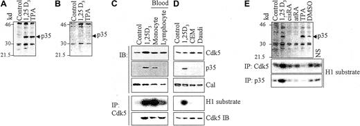 Fig. 1. Demonstration of the presence of p35Nck5a in cells with monocytic phenotype. / (A) Presence of a 35-kd protein immunoreactive with an antibody to Nck5a in HL60 cells induced to monocyte phenotype by exposure to 10−7M 1,25D3, or to macrophage phenotype by 10−8M TPA for 96 hours. The migration of size markers is indicated on the left side of the panel in kilodaltons. (B) An immunoblot (IB) run in parallel to the one shown in panel A, but probed with antibody that was preblocked with the immunizing peptide. Note the absence of the 35-kd band. (C) The 3 upper panels show IBs for the indicated proteins (Cal indicates calreticulin, a loading control) in lysates of monocytes and lymphocytes from blood of healthy volunteers, and from undifferentiated (negative control) and differentiated HL60 cells (10−7M 1,25D3 for 96 hours) as a positive control. The fourth panel shows kinase activity associated with Cdk5 immunoprecipitated (IP) from these lysates using histone H1 (H1) as the substrate and the bottom panel the Cdk5 protein content in these IPs demonstrated by immunoblotting. (D) Similar analysis of lymphocytic cell lines. (E) Absence of p35Nck5a in HL60 induced toward granulocytic phenotype by 96 hours of treatment with 10−6M 9-cis retinoic acid (cisRA) or all-trans retinoic acid (atRA). HL60 cells treated with monocyte/macrophage inducers show strong p35 bands, whereas cells treated with 1.25% DMSO for 96 hours show a faint 35-kd band. The bottom panels demonstrate Cdk5- and p35Nck5a-associated kinase activity showing a strong signal for 1,25D3-treated HL60 cells, a weak signal for DMSO-treated cells, and only background levels in untreated RA-treated or TPA-treated cells. The background level was determined by incubation of the extract with beads that were not coated with the antibody to either Cdk5 or p35Nck5a (marked NS, nonspecific). The data shown illustrate 4 similar experiments.