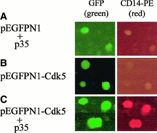 Fig. 4. Transfection of Cdk5 together with p35NcK5a induces a monocytic phenotype. / (A) Undifferentiated HL60 cells were transfected by electroporation with the pEGFPN1 plasmid, which can express the green fluorescent protein (GFP), together with p35Nck5a, or (B) with a plasmid expressing GFP-Cdk5 fusion protein alone, or (C) cotransfected with pEGFPN1-Cdk5 together with a plasmid expressing p35Nck5a. The transfected cells were incubated for 24 hours, then stained with PE-labeled antibody to CD14, a marker of myeloid monocytic phenotype, and examined under a fluorescent microscope using different filters. The green color (FITC filter 488-509 nm) indicates the expression of the GFP protein, whereas the red color (rhodamine filter 504-534 nm) shows monocytic differentiation. Note that transfection of Cdk5 and p35Nck5a together induces the monocytic marker. These experiments were repeated 4 times. Magnification, × 200.