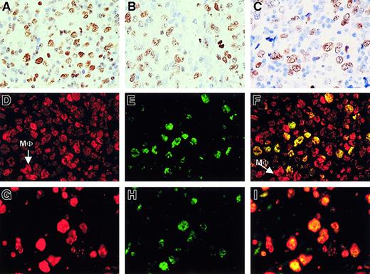 Fig. 1. Large B-cell lymphoma centroblasts are BMI-1+/EZH2+ that coexpress MIB1+. / (A-C, first row) Immunohistochemistry (IHC) of large B-cell lymphoma with numerous centroblasts shows clear expression of BMI-1 (A), EZH2 (B), and Mib-1/Ki67 (C). Large brown-staining cells are positive. Small lymphocytes also stain for BMI-1 (A), whereas these cells are negative for EZH2 and Mib-1/Ki-67. Photographs are taken from different parts of the tumor. One representative example is shown. Original magnification, 63× objective. (D-F, second row) Immunofluorescence (IF) of large B-cell lymphoma shows red staining for BMI-1 (D), green staining for EZH2 (E), and overlay photographic exposure with yellow cells indicative of centroblasts expressing both BMI-1 and EZH2 (F). Note that bright BMI-1+ (red) cells are probably macrophages (MΦ), as indicated in panels D and F. Note that small (infiltrating) lymphocytes in panels D to F show expression of BMI-1 but not of EZH2, as expected. (G-I, third row) IF of large B-cell lymphoma shows expression of Mib/Ki67 in red (G) and EZH2 in green (H). Double fluorescence confirms the coexpression of these proteins in the nuclei of tumor cells (J, overlay photographic exposure with yellow nuclei). Same example as in panels D to F is shown in panels G to I. All IF pictures were taken with 63× objective.