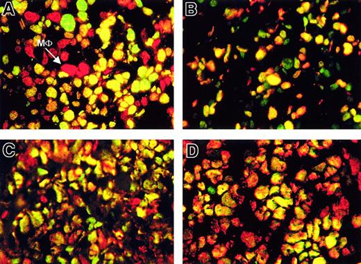 Fig. 2. Neoplastic cells in mantle-cell lymphoma and Burkitt lymphoma coexpress BMI-1, EZH2, and Mib-1/Ki-67. / (A-B, first row) Double immunofluorescence of mantle cell lymphoma (MCL) shows BMI-1 and EZH2 with a majority of yellow (double-positive) tumor cells. The technique used is similar to that used in Figure 1with single red and single green colors (for clarity, only double-exposure overlay photographs are shown). Yellow cells are indicative of both green and red fluorescence. Note that bright red cells are BMI-1+ macrophages (MΦ). Three green cells (A, top) show distinct speckled yellow staining, whereas most other nuclei are evenly yellow (double-positive for BMI-1 and EZH2). (B) Double IF for EZH2 and Mib-1/Ki-67 (green and red, respectively) with most cells double-positive (yellow). Single green staining cells are referred to in the text. (C-D, second row) Double IF of Burkitt lymphoma (C) shows BMI-1 and EZH2 (red and green, respectively) with a majority of yellow (double-positive) tumor cells. (D) Double IF for Mib-1/Ki-67 and EZH2 (red and green, respectively) with most cells double-positive. Single-color controls in panels A to D are omitted. Photographs were taken from one representative experiment for each lymphoma (63× objective).