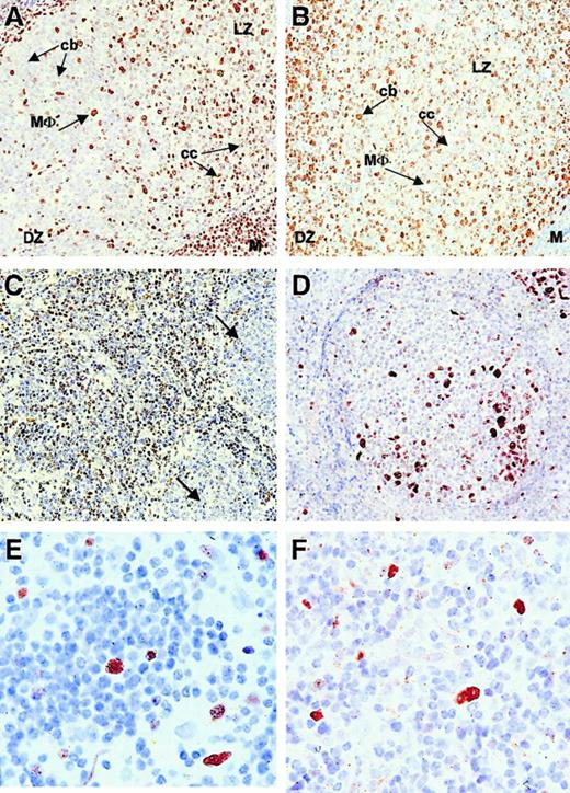 Fig. 3. Immunohistochemistry (IHC) and immunofluorescence (IF) of low-grade follicular lymphoma showing BMI-1low/EZH2− neoplastic centrocytes and BMI-1low/EZH2+ centroblasts. / (A-B, first row) IHC on reactive follicle with BMI-1 (A) and EHZ2 (B). Note that macrophages are BMI-1+ (MΦ) and EZH2−, centrocytes (cc) are BMI-1+ and EHZ2−, whereas centroblasts (cb) are BMI-1−but EZH2+. M, mantle cells (BMI-1+EZH2−); DZ, dark zone; LZ, light zone. Original magnification, 20× objective. (C-D, second row) IHC on low-grade follicular lymphoma. (C) Reactive centrocytes mainly on the left and neoplastic centrocytes mainly on the right side of the image (arrows). Reactive centrocytes are clearly BMI-1+, whereas neoplastic (larger) centrocytes are weakly positive and negative. (D) Residual germinal center overrun by neoplastic centrocytes. Residual centroblasts are EZH2+. Original magnification, 20× objective. (E-F, third row) IHC on low-grade follicular lymphoma (detail) showing Mib-1/Ki-67+ neoplastic centroblasts (E) and, with similar magnification, EZH2+ centroblasts (F). Original magnification, 63× objective. All photographs are from a representative experiment with one low-grade follicular lymphoma (Berard grade I/II).