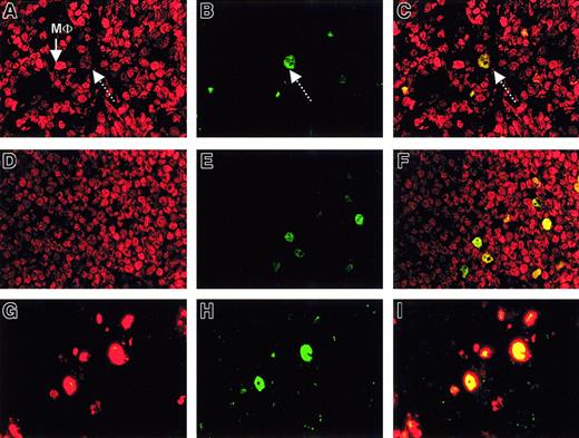 Fig. 4. Low-grade follicular lymphoma and small lymphocytic lymphoma show BMI-1low/EZH2+ centroblasts associated with cycling cells. / (A-C, first row) IF on follicular lymphoma (Berard grade I/II) with BMI-1 (red fluorescence) and EZH2 (green fluorescence). BMI-1 expression is detectable in most centrocytes (A). Large, bright red cells are macrophages (MΦ). Weak but distinct BMI-1 expression is detectable in neoplastic centroblasts (dotted arrow in A), which are also EZH2 (B; arrow). This produces a yellow signal in C. (D-F, second row) IF for BMI-1 (red fluorescent signal) and EZH2 (green fluorescent signal) on lymphocytic lymphoma. BMI-1 expression is detectable in almost all tumor cells (D), and a limited number of cells are EZH2+ (E). These cells coexpress BMI-1, producing a weak yellow signal in panel F (overlay photographic exposure) similar to that in panel C. (G-I, third row) IF for Mib-1/Ki-67 (red fluorescence) and EZH2 (green fluorescence) on follicular lymphoma. (G) Mib1/Ki67+ cells. (H) EZH2+ cells (using a stronger Alexa fluorescent probe than the FITC probe in panel B). (I) Overlay photographic exposure showing overlap between EZH2 and Mib/Ki67. One representative example is shown. Lymphocytic lymphoma gave a comparable result (not shown). All photographs were taken with a 63× objective.