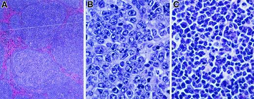 Fig. 2. MCL1 transgenic mice demonstrate a spectrum of lymphoma subtypes. / Lymphoma specimens from mice exhibiting disseminated disease were fixed in 10% buffered formalin, sectioned with a microtome (4- to 5-μm sections), and stained with hematoxylin and eosin (hematoxylin 2 and eosin progressive staining system, Richard Allan Scientific, Kalamazoo, MI). The lymphoma shown in panel A was photographed at a magnification of × 40 and those in panels B and C at a magnification of × 500. (A) Follicular lymphoma. (B) Diffuse large-cell lymphoma. (C) Polymorphic lymphoma.