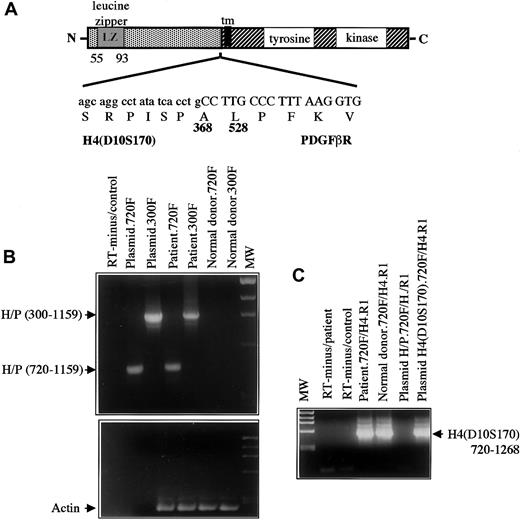 Fig. 4. Structure and RT-PCR of H4/PDGFβR fusion. / (A) Structure of the H4/PDGFβR fusion. H4 is fused at amino acid 381 in frame to the PDGFβR gene beginning at amino acid 528. The breakpoint within PDGFβRis identical to that in the TEL/PDGFβR andHIP1/PDGFβR fusions. (B) RT-PCR of the H4/PDGFβRfusion. RNA was extracted from leukemic cells containing the t(5;10)(q33;q22) and from a normal donor and was used as a template for RT-PCR as described in “Materials and methods.” Two sets ofH4/PDGFβR primers, denoted 300F and 720F, were used.H4/PDGFβR-specific transcripts were detected in the leukemic sample but not in the normal control. (C) RT-PCR ofH4(D10S170) was also performed to demonstrateH4(D10S170) expression in both normal and patient samples. As expected, signal was seen in patient, donor, and H4containing plasmid with the use of the 720F primer set, but not in theH4/PDGFβR plasmid.