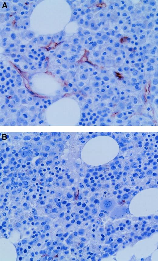 Fig. 1. Microvessels in APL and control bone marrow biopsy specimens. / (A) Many microvessels were evident in this diagnostic bone marrow trephine biopsy specimen from a patient with APL. (B) In contrast, this normal control bone marrow biopsy sample had few microvessels. Microvessels were highlighted by immunohistochemistry with the use of antibodies to CD34 (brown). Original magnification, 600 ×.