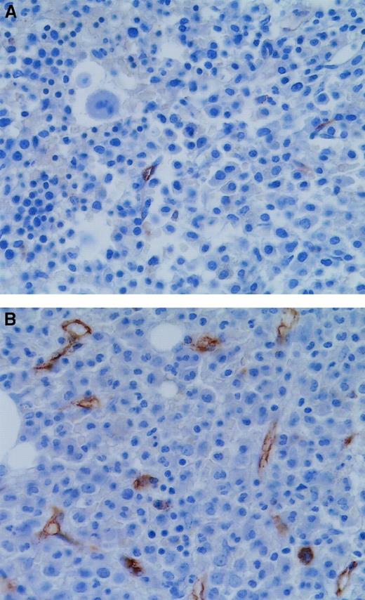 Fig. 4. Microvessels in APL bone marrows at diagnosis and remission. / Bone marrow trephine section from an APL patient in ATRA-induced remission (A) had fewer microvessels than a diagnostic bone marrow biopsy specimen from the same patient (B). Microvessels were highlighted immunohistochemically with the use of antibodies to CD34 (brown). Original magnification, 600 ×.