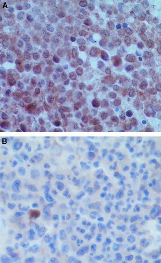 Fig. 6. VEGF staining in APL bone marrows at diagnosis and remission. / (A) Diagnostic bone marrow biopsy sample from a patient with APL showed strong VEGF staining in the tumor cells. (B) Bone marrow biopsy sample from the same patient obtained after remission induced by ATRA therapy showed decreased VEGF staining intensity.