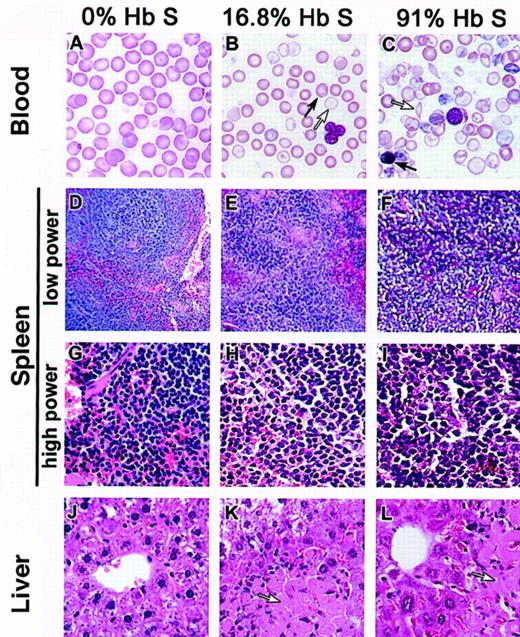 Fig. 1. Progressively severe hematologic and pathologic changes in mixed hematopoietic chimeras containing an increasing percentage of HbS. / Histologic images are shown for a representative sample of chimeric mice as follows: lethally irradiated C57BL/6 mouse reconstituted with normal C3H.SW bone marrow (left column), mixed chimeric mouse with 16.8% HbS (19.6% normal myeloid chimerism) generated by lethal irradiation followed by reconstitution with a mixture of transgenic sickle and C3H.SW bone marrow (middle column), and mixed chimeric mouse with 91% HbS (0.2% normal myeloid chimerism) generated by lethal irradiation and reconstitution with only transgenic sickle bone marrow (right column). Mice were humanely killed for histologic analysis 6 months after transplantation. (A-C). Peripheral blood smears demonstrate increasing hypochromia and polychromasia with increasing levels of HbS. Two morphologically distinct populations of RBCs are apparent in the 16.8% sickle chimera, as indicated by arrows in panel B. The 91% sickle chimera, panel C, has nucleated RBCs (dark arrow) and sickle forms (open arrow). (D-I) Sections of spleen are shown at low power (D-F) and high power (G-I). Low power illustrates loss of follicular architecture in mice with a majority of HbS. High power illustrates increasing extramedullary hematopoiesis as well as increasing congestion and hemosiderin deposition in mice with larger proportions of HbS. (J-L) Liver infarcts (arrows) are present in mice with as little as 16.8% HbS in the blood, as well as in mice with a majority of HbS. Magnifications: panels A-C, 160 ×; D-F, 40 ×; G-L, 100 ×.