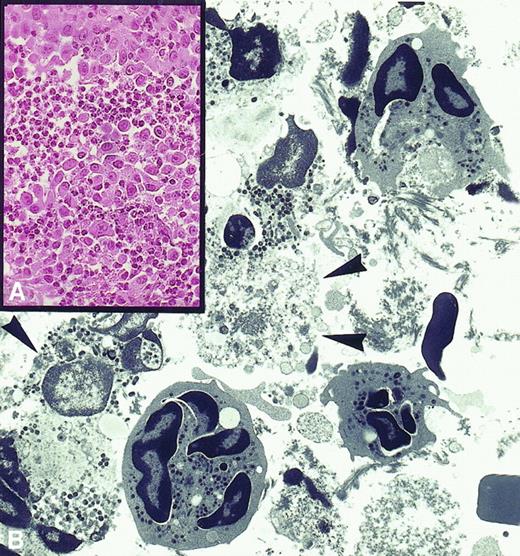 Fig. 2. PMN-induced tumor destruction. / (A) Rejection area of subcutaneously injected tumor cells engineered to release IL-2 is massively infiltrated by polymorphonuclear leukocytes (× 630). (B) Electron micrograph showing that these are neutrophils at various stages of disorganization and that their exocytosed granules are in close contact with severely damaged or necrotic tumor cells (× 2750).