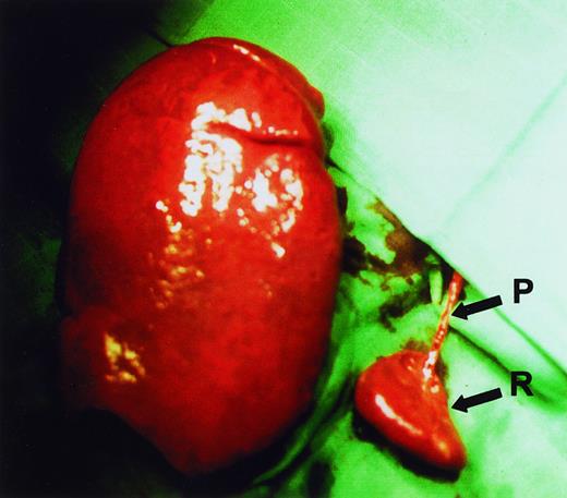 Fig. 1. Spleen sizes. / Relative sizes of the remnant spleen (R) and the enlarged excised spleen in a HS patient during surgery. It can be seen that a single vascular pedicle (P) provides blood supply to the remnant spleen.