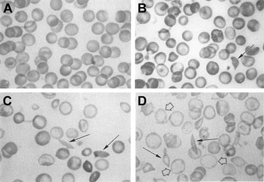 Fig. 2. Morphology of red cells from C57BL, NY1KO γH, NY1KO γM, and BERK mice. / (A), C57BL; (B), NY1KO γH; (C), NY1KO γM; and (D), BERK mice. Note that the NY1KO γH mouse red cells are hyperchromic when compared with C57BL, and the BERK mouse red cells are hypochromic (open arrows). Solid arrows indicate circulating irreversibly sickled cells (ISCs) that can be found in all 3 types of transgenic mice. The red cells of the NY1KO γH mouse are normochromic or hyperchromic when compared with the control C57BL mouse and, in contrast, the red cells of the BERK mouse are severely hypochromic when compared with the C57BL mouse. These results are in agreement with the Percoll-Larex continuous density gradients (Figure 1), which show that the BERK mice have a much lower MCHC than either NY1KO γM or γH mice. This is particularly apparent when the BERK mice are compared with the NY1KO γM mice that have approximately the same average reticulocyte counts.