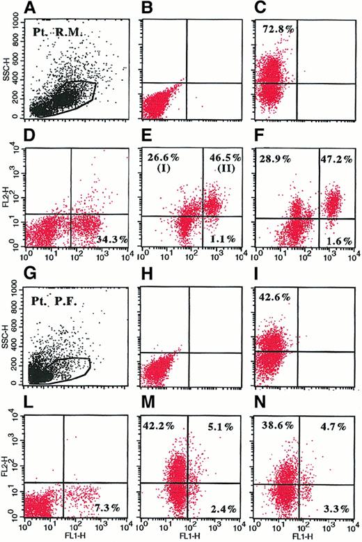 Fig. 2. Representative dot plots derived from analysis of intracellular IL-6 in BMMC by flow cytometry in 2 representative patients with MM. / BMMC were stimulated for 6 hours with 1 μ/mL LPS (A-E, G-M) or culture medium (F,N) in the presence of 2 μM monensin. Cells were fixed, permeabilized (C-F, I-N), and stained with PE-conjugated anti–IL-6 mAb (Y axis) and FITC-conjugated anti-syndecan-1 mAb (X axis). Shown are BMMC gate (A,G); unpermeabilized (B,H) and permeabilized (C,I) LPS-stimulated BMMC (B-C and H-I) stained with PE-conjugated anti–IL-6 mAb and isotype control; LPS-stimulated BMMC incubated with 500 U/mL recombinant IL-6 before staining and stained with PE-conjugated anti–IL-6 mAb and FITC-conjugated anti-syndecan-1 mAb (D,L); and LPS-stimulated (E,M) and unstimulated (F,N) BMMC (E,F and M,N) stained with PE-conjugated anti–IL-6 mAb and FITC-conjugated anti-syndecan-1 mAb. In panel E, I shows syndecan-1−/IL-6+ cells corresponding to paracrine IL-6 production; and II shows syndecan-1+/IL-6+ cells corresponding to autocrine IL-6 production.