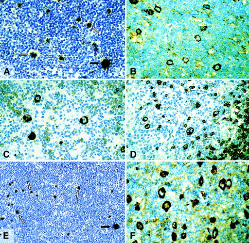 Fig. 1. Lymphocyte predominant Hodgkin disease. / (A,E) Radioactive in situ hybridization with probes specific for Igγ and Igλ mRNA, respectively. The L&H cells (white arrows) are positive with an intensity between that seen in plasma cells and B cells (black arrows). (B-D,F) Immunostaining for Igγ, -μ, -δ, and -λ, using a avidin-biotin-peroxidase method. The L&H cells display a strong labeling.