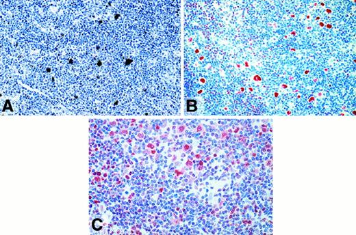 Fig. 3. Lymphocyte predominant Hodgkin disease. / (A) Radioactive in situ hybridization with a probe specific for Oct2. L&H cells show dense signals. (B) Immunostaining (APAAP) for Oct2. The nuclei of the L&H cells are strongly labeled. (C) Immunostaining (APAAP) for BOB.1/OBF.1. The nuclei and the cytoplasma (less intense) of the L&H cells display a moderately strong labeling.
