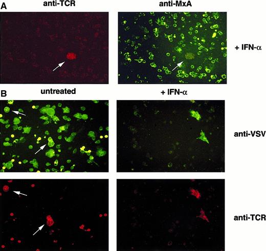 Fig. 3. Clonal T cells fail to establish MxA-dependent antiviral status and allow selective viral replication. / Immunofluorescence analysis of VSV-infected PBMCs from patients with CTCL. (A) PBMCs were either treated with IFN-α (+IFN-α) or left untreated (untreated). (B) PBMCs were subsequently infected with VSV. Cells were harvested, fixed with acetone, and immunostained using antibodies specific for MxA and TCR Vβ6.7 (A) or VSV and TCR Vβ6.7 (B).