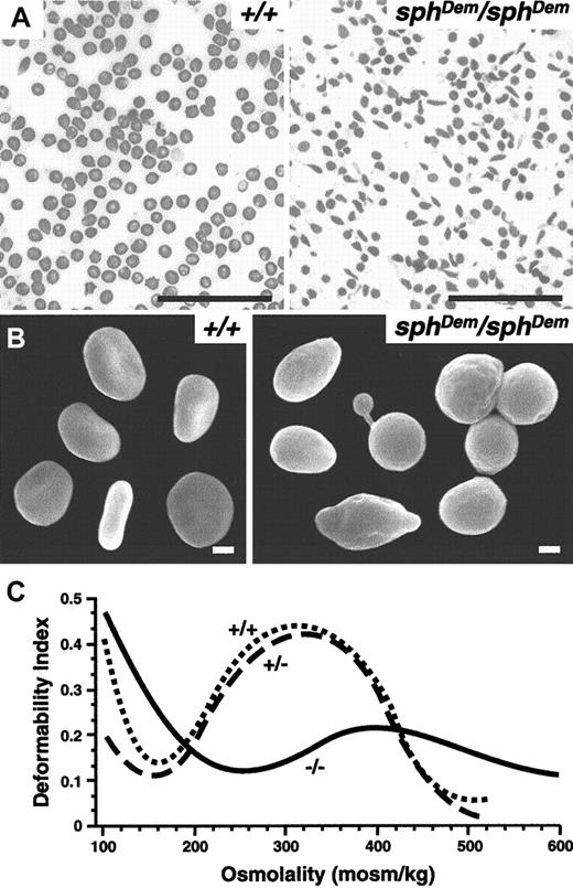 Fig. 1. sphDem/sphDem mice have severe HE. / (A) Wright-stained peripheral blood smears from +/+ (left panel) andsphDem/sphDem (right panel) mice. Note the presence of spherocytic, elliptocytic, poikilocytic, and fragmented RBCs in the mutant mice. Bar, 5 μm. (B) Scanning electron microscopy of RBCs from +/+ (left panel) andsphDem/sphDem (right panel). Note the abnormally shaped RBCs in the mutant. Bar, 1 μm. (C) Osmotic deformability profiles of RBCs from wild type (+/+), heterozygous (sphDem/+), and homozygous (sphDem/sphDem) mice.