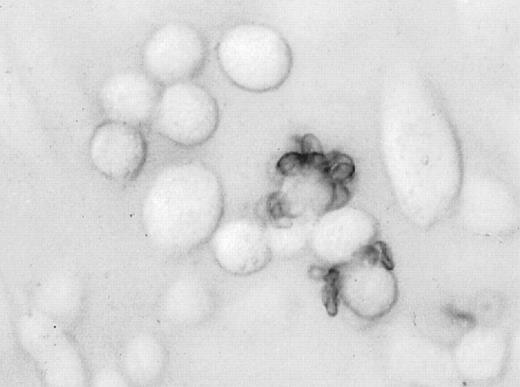 Fig. 2. RBCs bind to CHO cells expressing a. / P falciparum malarial protein. CHO cells were transiently transfected with the glycophorin A binding domain of theP falciparum protein ligand, EBA-175. Control and PEG-modified RBCs were assessed for binding. RBC rosettes are shown. (Magnification: × 400.)