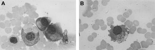 Fig. 1. Phagocytic plasma cells. / May-Grünwald-Giemsa stain (original magnification × 1000).