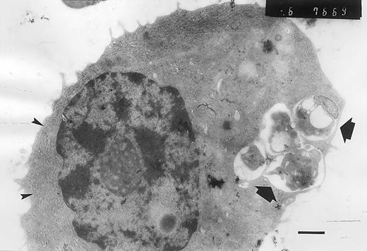 Fig. 2. Atypical plasma cell containing phagocytic vacuoles. / The phagocytic vacuoles are indicated by arrows, and the large amount of rough endoplasmic reticulum, by arrowheads. There is a nuclear chromatin typically resembling the appearance of a “cartwheel” (bar = 1 μm).