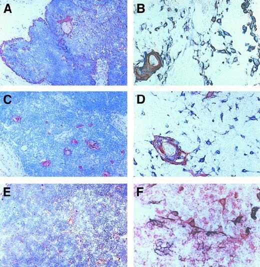 Fig. 2. Immunohistochemical analysis of IP-10, Mig, and I-TAC expression in human thymus. / Sections were immunostained with anti–IP-10, Mig or I-TAC (red) Ab, using the avidin-biotin-peroxidase method. IP-10 (A), Mig (C), and I-TAC (E) showed a localization similar to that found by in situ hybridization (Figure 1). Double immunostaining for CK (bluish gray) and IP-10 (B) or Mig (D) (red) reveals that the 2 chemokines are produced by thymic epithelial cells (purple brown), whereas I-TAC is constitutively produced not only by epithelial cells (purple brown), but also by several other thymocytes (F) (red). Original magnification × 400.