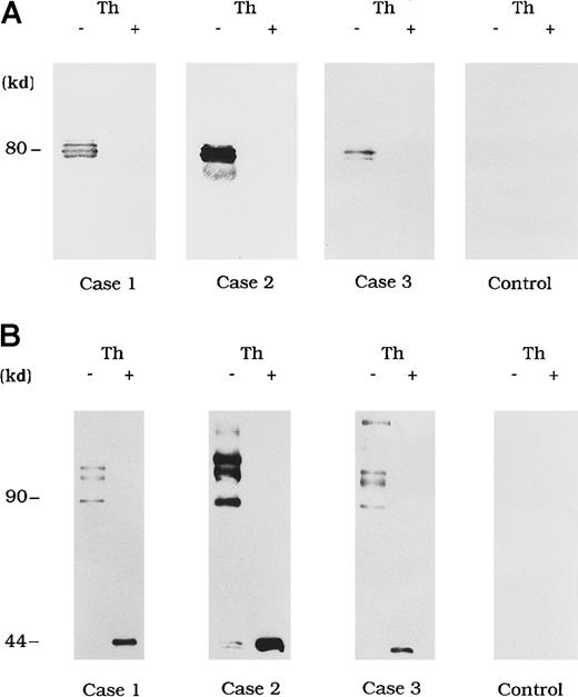 Fig. 3. Direct detection of FVIII and autoantibody immune complexes in plasma. / Each FVIII band was detected by using mAb NMC-VIII/10 (A), which recognizes the 80-kd LCh but not the 72-kd LCh, or mAb JR8 (B), which recognizes the 44-kd HCh. Th (−) represents untreated material and Th (+) represents the material treated with thrombin. Type 1 autoantibody plasma was used as a control.