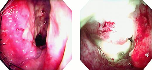 Fig. 1. Endoscopic findings. / The patients' right nasal cavities show granulomatous tumors and white necrosis. Left panel, patient 1; right panel, patient 2.