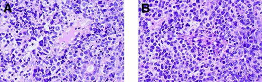Fig. 2. Histopathology. / Primary lesions show invasion of tumor cells to small blood vessels. (A) Patient 1. (B) Patient 2. (Hematoxylin-eosin, final magnification × 140).